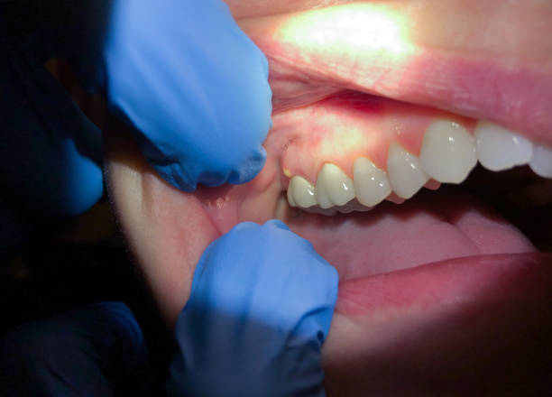 Best Broken or Cracked Tooth Emergency Dentist in Upper Greenwood Lake, NJ
